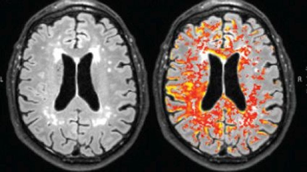 Having OCD may Triple a Person's Odds for a Stroke!!!